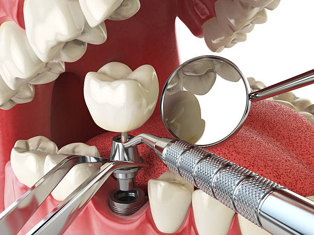 Best Lost Filling or Crown Replacement in Duenweg, MO